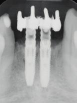 For the final restoration, a NobelProcera Implant Bridge Zirconia was manufactured.