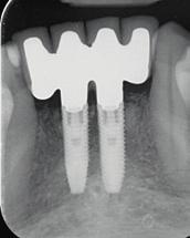 The pilot drill template was properly seated immediately after tooth extraction (left).