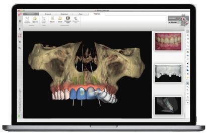 NobelClinician NobelClinician scientific evidence With its SmartFusion technology, the NobelClinician Software combines 3D imagery of anatomical structures with soft tissue information from optical