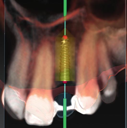 NobelClinician Optimized implant positioning With NobelClinician, the type and size of the planned implants, their position in the bone and relation to the adjacent teeth or implants, and their
