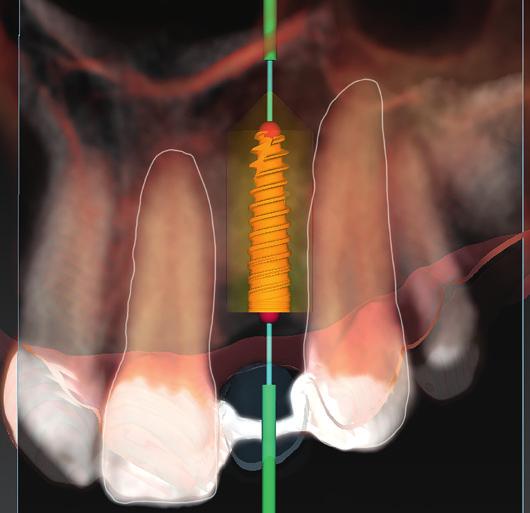 Katsoulis and colleagues evaluated prosthetically driven digital implant planning, reporting full control of the implant axis in relation to the prosthetic restoration and facilitated decision making