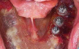 First described in a case report, the depth of the expanded-condensing osteotome was digitally planned to puncture the bony sinus floor and the Schneiderin membrane was raised without perforation.