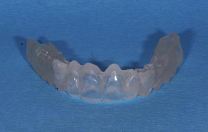 denture, requires adaptation with guided surgery in postextraction cases.