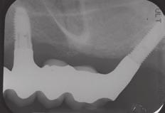 Bone loss from insertion to 2 years, for implants placed in both extraction and healed sites, was 0.85 mm (SD 1.