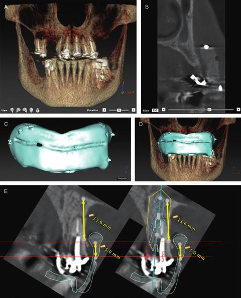 Key studies VOLU ME 1 5 NUMBER 1 F EB R U A R Y 2 01 3 I S S N 1 523-0 8 9 9 CLINICAL IMPLANT DENTISTRY and Related Research EDI T OR S: William Becker and Lars Sennerby This journal is available