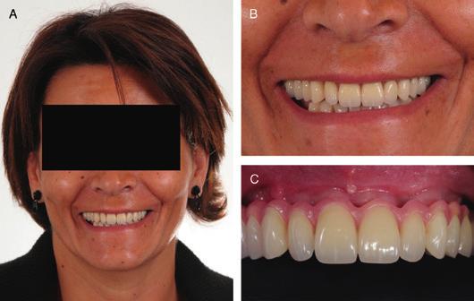 2013 [epub ahead of print] Clinical preoperative situation. A, Nonfunctional and nonaesthetic teeth-supported overdenture. B, Situation after removal of the overdenture.