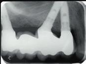 An acrylic resin interim restoration reinforced with metal was placed immediately. 5 to 6 months after initial loading, a zirconia framework was manufactured, and a definitive prosthesis was placed.