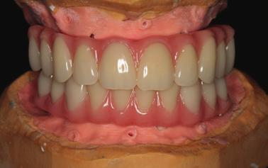 Provisional all-acrylic fixed prosthesis in the articulator before surgery. Anterior implant placement. Mandibular intra-oral postoperative occlusal view with all-acrylic prosthesis.