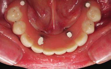 Original abstract Background: There is a need for long-term studies on complete edentulous flapless rehabilitations.