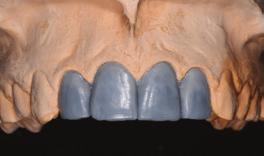 the osseous crest, along with adequate bone height and width to receive implants.