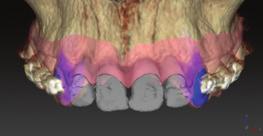 subsequent restoration with single crowns. Implants were planned relative to the final tooth position.