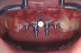 Integrated treatment workflow Implant insertion and immediate provisionalization Immediately after atraumatic