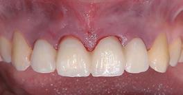 Provisional and final restoration Zirconia abutments were seated and tightened with the recommended torque and