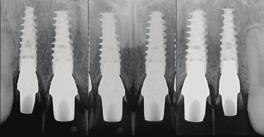 Postoperative periapical radiographs showed precise implant placement.