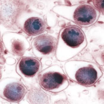 Chlamydophila pneumoniae also affects young