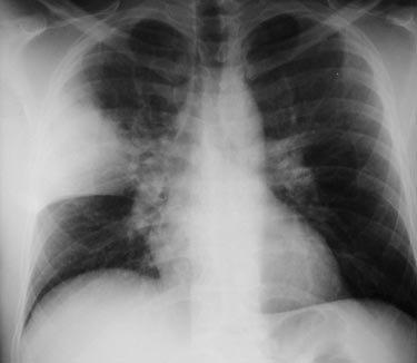 Lobar pneumonia: homogenous consolidation of one or