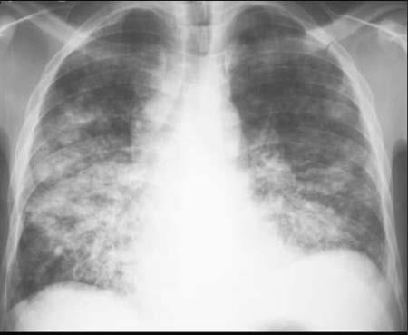 Bronchopneumonia: patchy alveolar consolidation