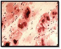 Case cont : Microscopic appearance : Gram stain