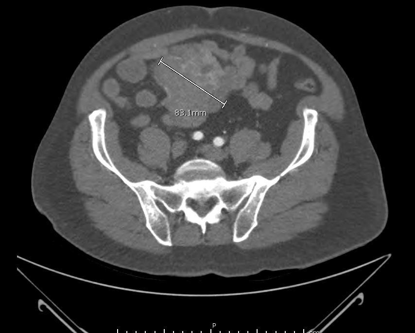 Clinical History: 59 yo male with past medical history of prostate carcinoma, presented with upper abdominal pain radiating to the back and melena.
