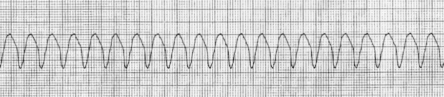 Fast Pulse - Wide QRS
