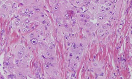 Fibrolamellar carcinoma: central scar Triad of microscopic