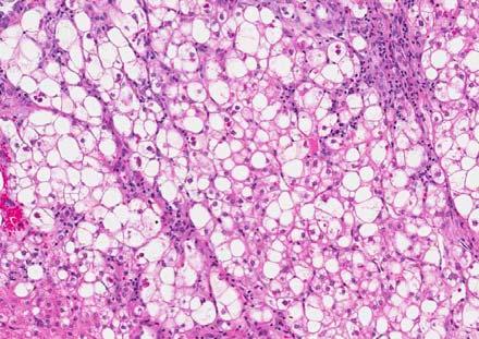 Fibrolamellar carcinoma common pitfalls Young age, non-cirrhotic liver: most are conventional HCC Scirrhous HCC: fibrosis Adenocarcinoma: Glands, mucin, CK7+ Neuroendocrine