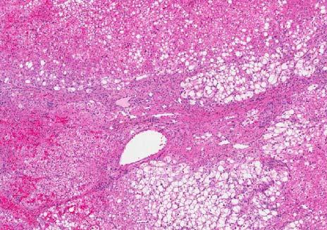Central scar, no atypia Glutamine synthetase: map-like staining Diagnosis: FNH with