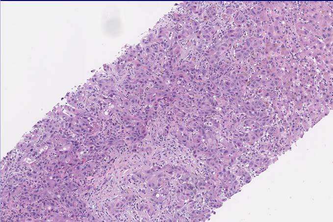Cholangiocarcinoma Lymph node dissection is routine Cholangiocarcinoma Gemcitabine-based or