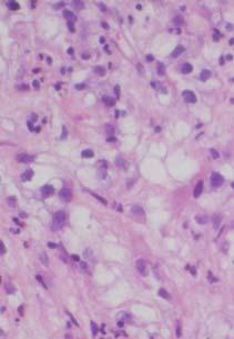 metastatic RCC HCC: Histologic variants WHO 2010 Scirrhous Fibrolamellar Sarcomatoid Lymphocyte-rich Other variants