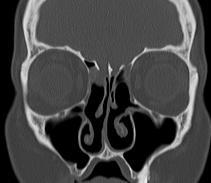 Preoperative disease severity at sites of subsequent skull base
