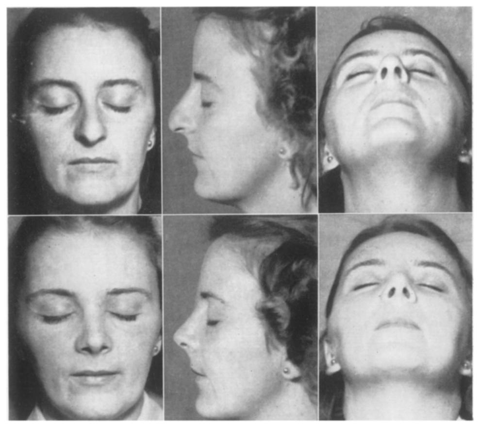 166 BRITISH JOURNAL OF PLASTIC SURGERY FIG. IO Before.--Hypertrophy of the cartilaginous framework of the nose. Square box-like tip. Asymmetry of nostrils. Treatment.