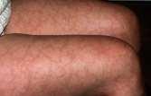 Symptoms based on size MVV: Cutaneous nodules Ulcers Livedo reticularis
