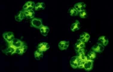 Antineutrophil cytoplasmic antibodies (ANCA) C ANCA=PR3 ANCA C=cytoplasmic