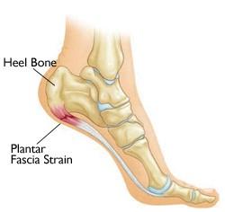 2 of 5 17 Oct 2015 11:04 AM Risk Factors In most cases, plantar fasciitis develops without a specific, identifiable reason.