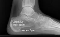 arch Repetitive impact activity (running/sports) New or increased activity Heel Spurs Although many people with plantar fasciitis have heel spurs, spurs are not the cause of plantar fasciitis pain.
