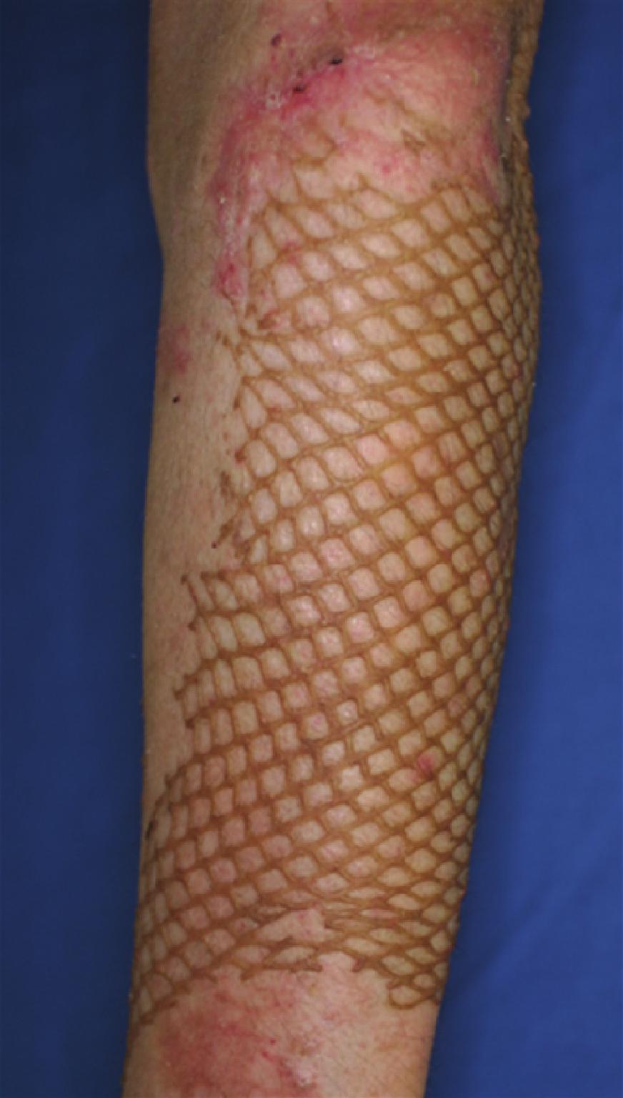 Plastic Surgery International Figure : Twenty eight-year-old male, mesh skin grafted scars on left forearm (deep burn caused by explosion, age of scar was months) before and after eight treatment.