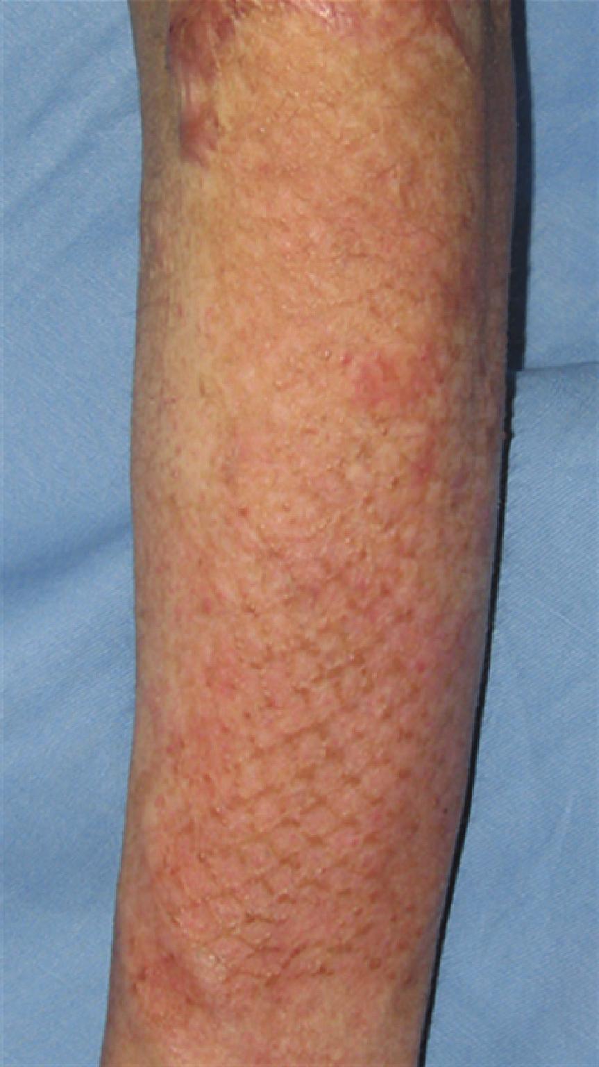Figure : Fifty three-year-old male, mesh skin grafted scars on left forearm (deep flame burn caused by accident, age of scar was 7 months) before and after one treatments.
