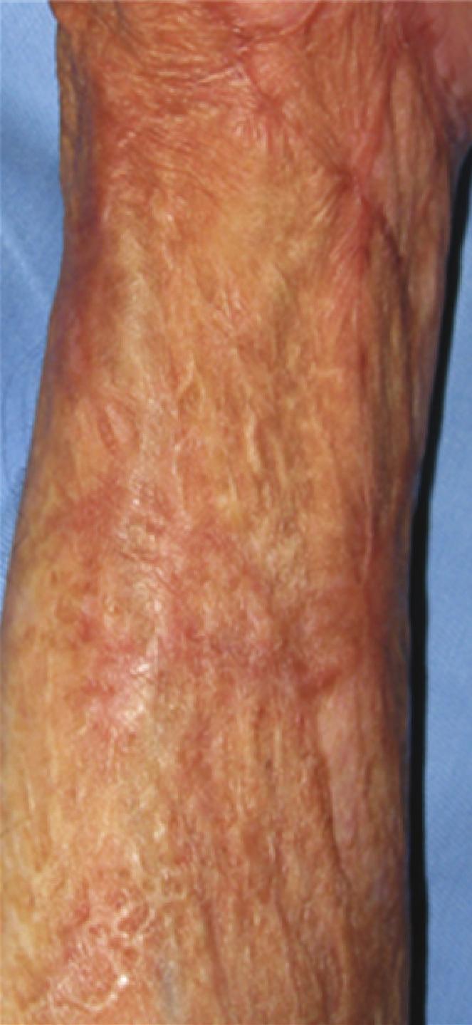 Case Age 4 8 5 4 5 st treatment from skin grafting male forearm months male forearm 6 months female leg months male forehead 7 months Sex Region Treatment times 8 8 performed at monthly intervals,