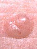 A red patch on the skin which may be itchy, painful or crusty.