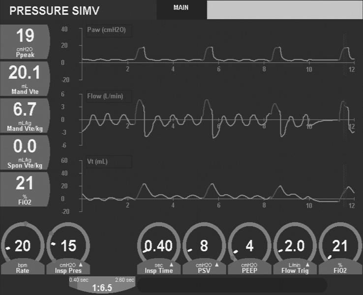 Patient/Ventilator Dysynchrony: Inappropriate Flow Trigger Graphic