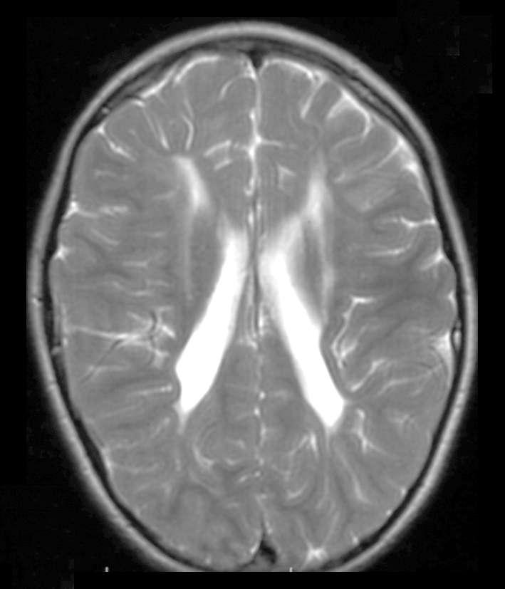 MRI Brain: Typical