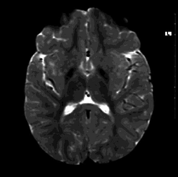 MRI Brain: iron deposition in basal