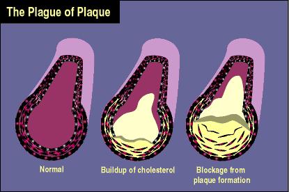Problem with too much Cholesterol Can cause atherosclerosis (clogging of
