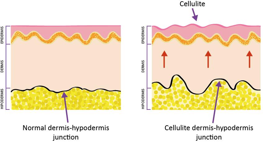 » In vivo efficacy: reduction of cellulite Reduction in the length of the dermis-hypodermis junction significantly reduced the length of the