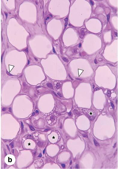 WHITE ADIPOSE TISSUE Cells: spherical when isolated polyhedral when closely packed Large cell: 50-150μm in diameter one huge droplet of lipid 85% cell s