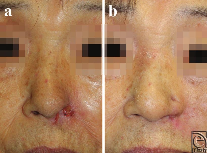 Case 2 OSAKI ET AL A 79-year-old woman was referred to us with a defect of her ala nasi and ulceration of the left nostril floor (Fig 2a).