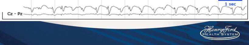 Before Case F 1 - F F3- C3 CJ- P3 P3-0 Treat severe sepsis Stat EEG Common pitfall missed non-convulsive status Trial of lorazepam, other AEDs F4- ' P4-0 _.