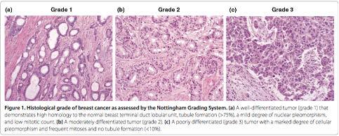 Tumor Grade Rakha et al.