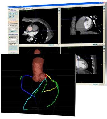 The COR Analyzer automatically recognizes the CT data and launches a sophisticated analysis process, which provides both final patient results and a detailed visualization of the findings.