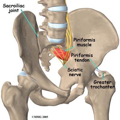 Piriformis syndrome can be painful, but it is seldom dangerous and rarely leads to the need for surgery.